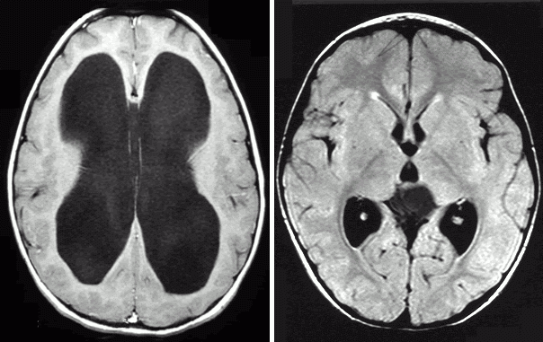 hydrocephalus-normal-non-normal-ct-scans_large