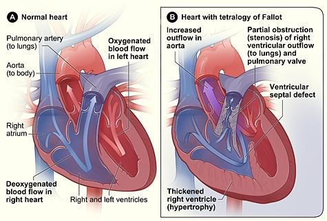 Source:https://www.nhlbi.nih.gov/health-topics/tetralogy-fallot This is an example of what a normal heart should look like compared to one with a heart condition